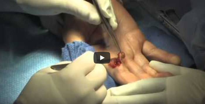 Excision of Tumor on Finger by Dr Leo Rozmaryn
